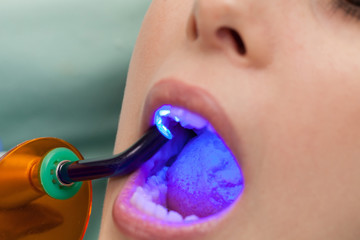 Dental obturation
