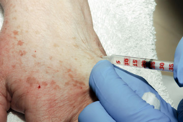 Microsurgery: Local anesthesia on the hand