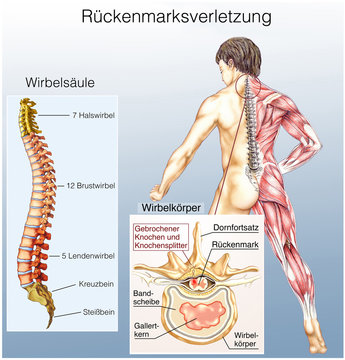 R&uuml;ckenmarksverletzung.Querschnittsl&auml;hmung