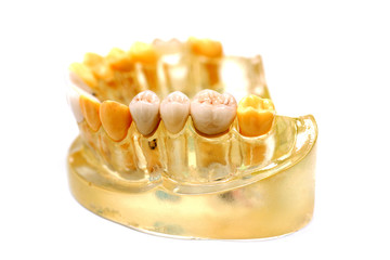 Dental implant artificial teeth and gum