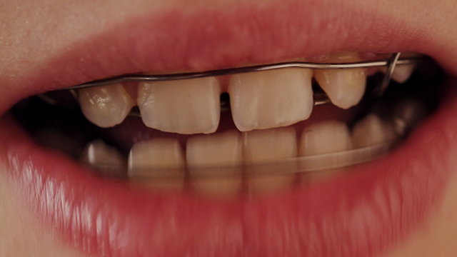 dental plate in the teeth