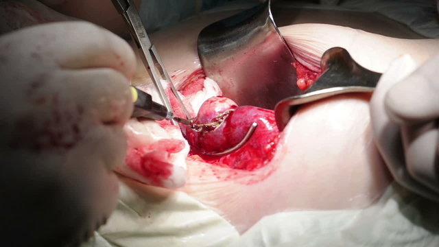 Surgery for cancer excision