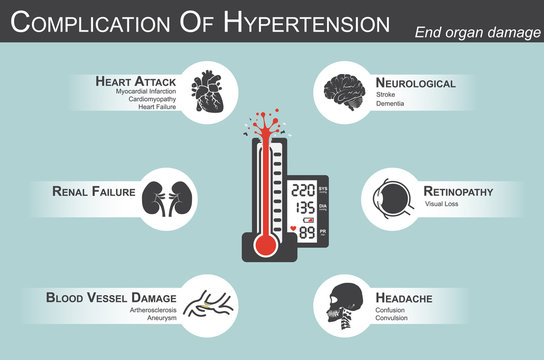 Complication of Hypertension(Heart attack : myocardial infarction , cardiomyopathy )(Brain : stroke , dementia )( visual loss )(Headache)(Renal failure)( Artherosclerosis , aneurysm ) end organ damage