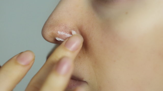 Herpes on the nose - Pretty young caucasian woman with herpes her on nose, close-up. Using an ointment for herpesHuman Virus