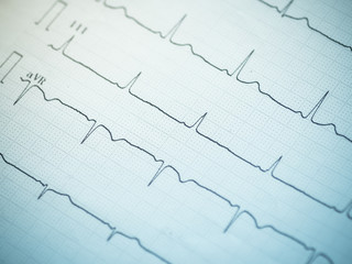 Close up of an electrocardiogram.