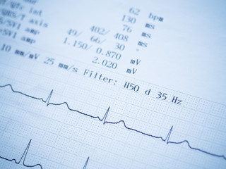 Close up of an electrocardiogram.