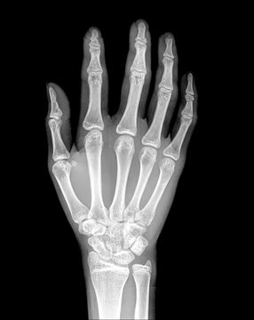 x-ray of painful arm fracture, isolated on black background