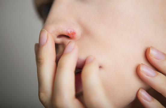 Herpes on the nose - young woman with herpes on her nose