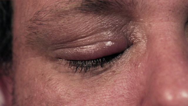 Man treating infected eye