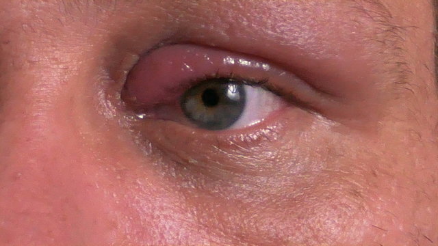 Man treating infected eye, 4K