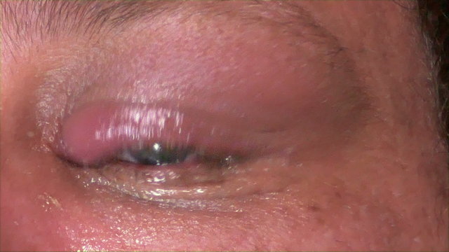 Man treating infected eye, 4K