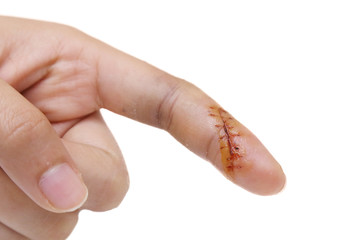isolated injured finger