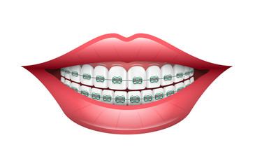 Dental Braces, Orthodontics, Dentistry, Teeth - 101555491
