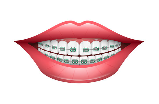 Dental Braces, Orthodontics, Dentistry, Teeth