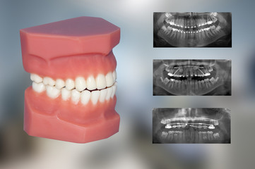 dental model and x-ray  of three fixed appliances used for ortho