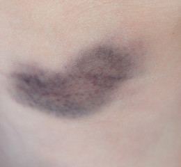 Bruise