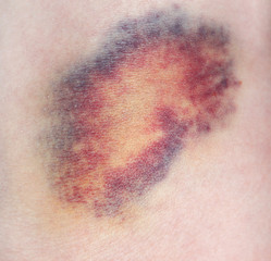 Bruise