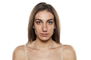 beautiful young women with problematic skin