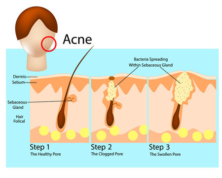 How acne develops. Acne stages. Formation of skin acne or pimple