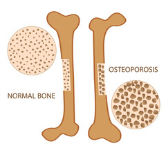 osteoporosis bone anatomy versus normal health bone. vector format illustration
