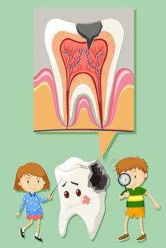 Boy and girl with tooth decay diagram