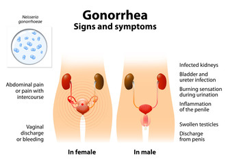 Gonorrhea or gonnococcal infection