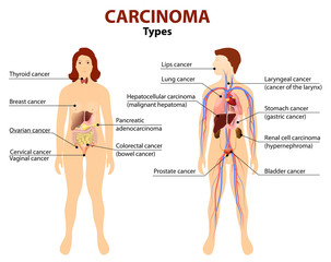Carcinoma