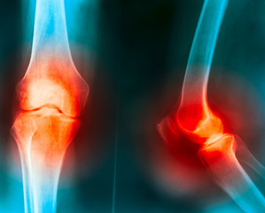 knee joint pain cause by knee truma,gout,rheumatoid,osteoarthritis of knee