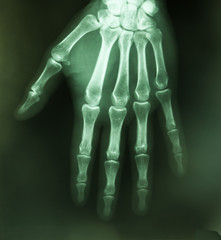 flim hand show area of joint pain
