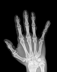 X-Ray image of human hands