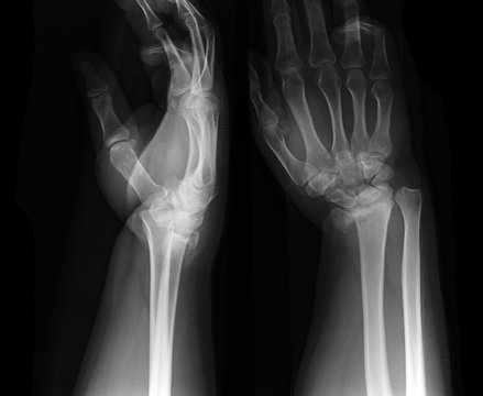 X-ray photos of hand bone fracture patients