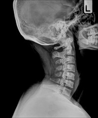 x-ray of the cervical spine / Many others X-ray images in my portfolio.