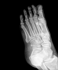 x-ray photo of feet