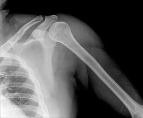 X-ray of shoulder joint / Many others X-ray images in my portfolio.