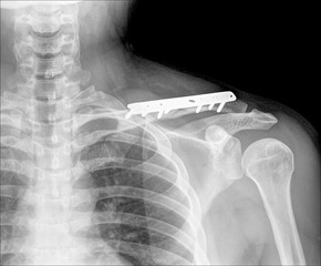 rengs snapshot of the shoulder joint with a bolt.
