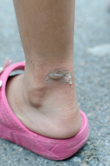 blister on ankle