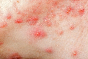 Fototapeta premium Nodular cystic acne skin