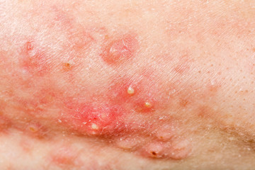Fototapeta premium Nodular cystic acne skin
