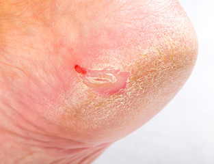 Dry skin on heel