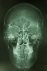 skull bone is show from skull radiography