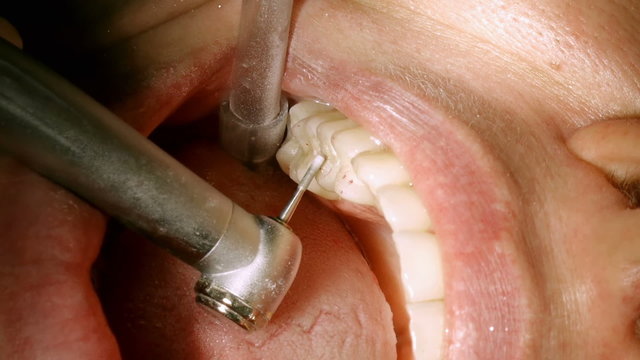 Fixing Height On Dental Inlays Red Marks With Audio