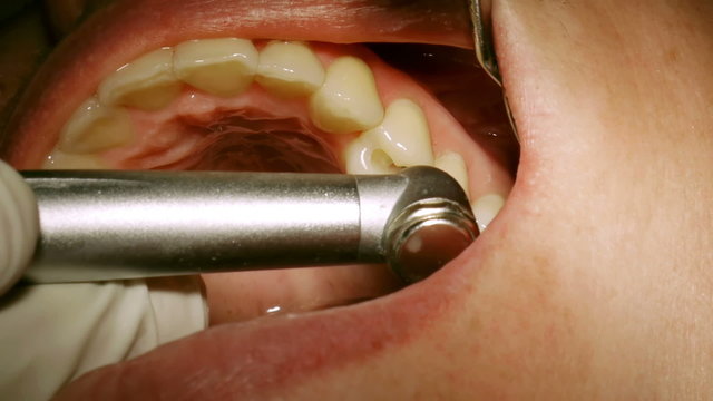 Dentist Drilling Cavities In Molars