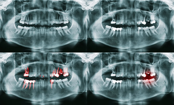 Many panoramic of dental X-Ray. Jaw with problem and not.