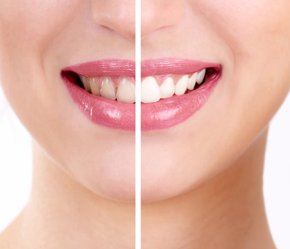 Smiling woman, teeth: before and after concept