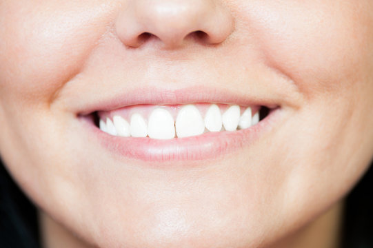Closeup with young white smile after whitening