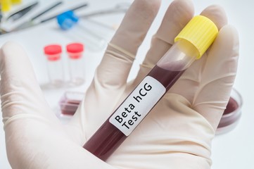 Test tube with blood for Beta hCG Test in hand.