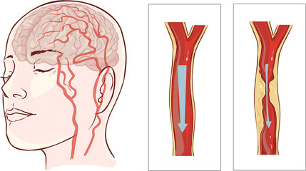 Vector illustration ofbrain stroke. Cerebral infarction