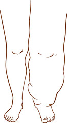 vector illustration of a Lymphedema of the disease