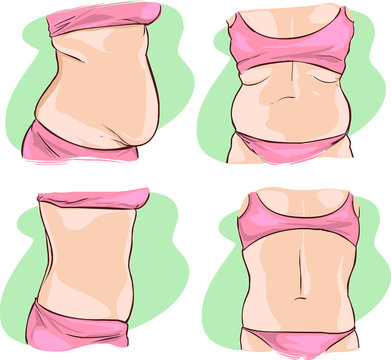 vector illustration of a Fat belly before and after treatment.
