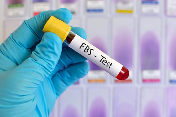 Fasting blood sugar (FBS) test